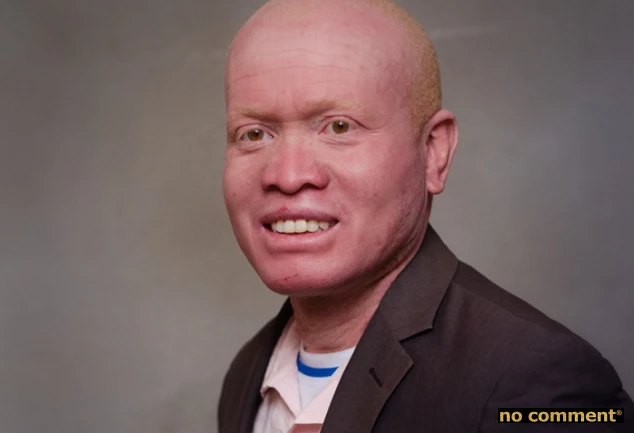 no comment - Soja Ramiandrisoa Fulgence « Les albinos sont en danger de mort »